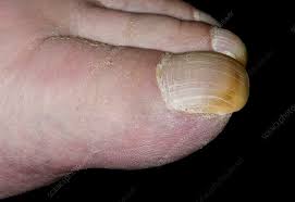 Image result for Clubbing nails feet