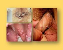 Infections mycose please enter mycose delivery postcode. Tratament Pentru Papiloma Virus Tot Ce Trebuie Sa Stii Despre Infectia Cu Hpv