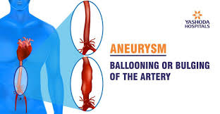 Aneurysms Its Causes Symptoms Diagnosis And Treatment 3 confirming with a diagnosis.