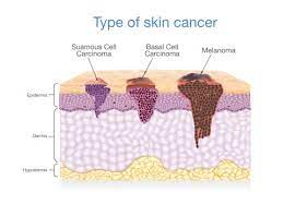three most common skin cancers it is estimated that one in seven people in the united states will develop some form of skin cancer during their lifetime. Skin Cancer Facts Signs Symptoms Treatment Summa Health