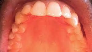 Image result for Canker sores symptoms roof of the mouth