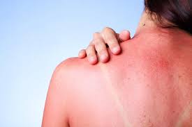 Of course, that doesn't apply if you have fair skin. the fair skinned among us never get a tan, so they always get sunburned. When You Should Have A Sunburn Checked Out By A Professional Family Medicine And Acute Care Of Sandhills Primary Care Practice