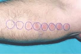 Image result for Pathergy