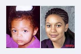 Parvovirus B19, Slapped Cheek Syndrome, On Rise in Washington