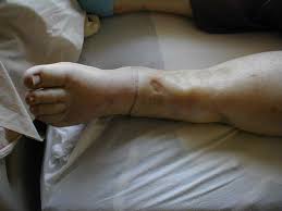 Image result for Edema Exam