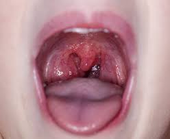 People with tonsil stones may not know what they are. What Are Tonsil Stones And How Are They Treated Simplemost