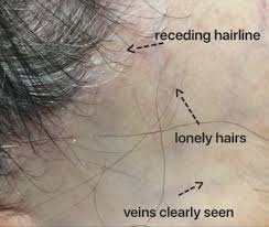 Frontal Fibrosing Alopecia Donovan Hair Clinic In 2020 Alopecia Hair Clinic Alopecia Hairstyles