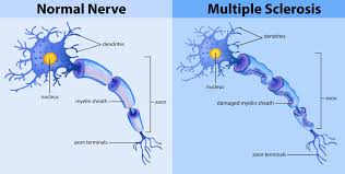 In multiple sclerosis (ms), damage to the myelin coating around nerve fibers in the central nervous this disruption of nerve signals produces an array of symptoms that are different for every person. Multiple Sclerosis Important Things You Need To Know