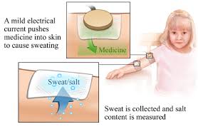 Image result for Sweat Chloride