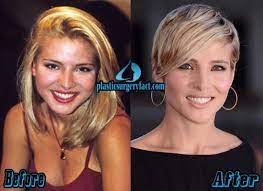 Check out before and after photos and the latest surgery news reports and information. Elsa Pataky Plastic Surgery Before And After Plastic Surgery Elsa Pataky Surgery