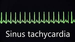 For some people, however, bradycardia doesn't cause symptoms or complications. Sinus Rhythm Bradycardia And Tachycardia Youtube