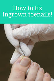 How To Fix Ingrown Toenails Toe Nails Ingrown Toe Nail Nail Remedies