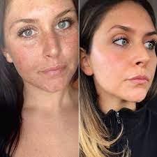 Ever used a vitamin c serum and noticed your skin looking darker, orange or more tanned? This Woman S Reddit Before And After Sun Damage Photo Is Going Viral