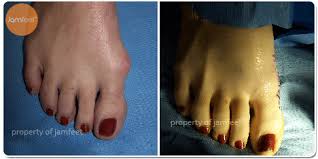 Bob baravarian discusses the different types of bunion surgeries including the lapidus bunionectomy and how to chose a bunion surgeon. Before After Bunion Surgery Photo Gallery Los Angeles Foot Doctor Beverly Hills