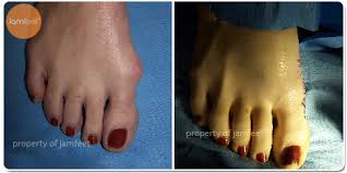 Try our symptom checker got any ot. Before After Bunion Surgery Photo Gallery Los Angeles Foot Doctor Beverly Hills
