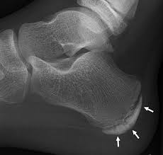 In the beginning perthes may cause no pain at all or appear as a painful limp. Sever S Disease Wikipedia