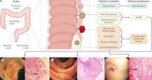 Colonic Diverticular Disease Nature Reviews Disease Primers