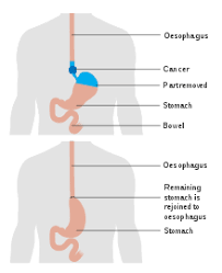 Minimally invasive esophagectomy (mie) has consistently been associated with improved perioperative outcome and similar oncological safety compared to open esophagectomy. Esophagectomy Wikipedia