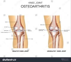 Osteoarthritis And Normal Knee Joint Anatomy Isolated On White Knee Joint Anatomy Osteoarthritis Knee Joint