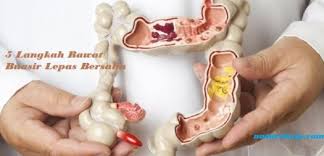 Buasir merupakan perkara biasa ketika hamil. Buasir Lepas Bersalin Cara Berkesan Hilangkan Bengkak Berdarah Pengedar Shaklee Malaysia