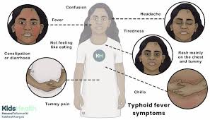 Image result for Typhoid Fever