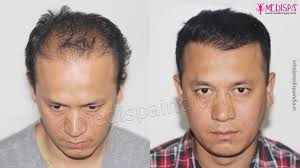 Provided me with a couple of post of free hair cuts. Hair Transplant In Bhubaneswar Hair Transplant Cost Bhubaneswar
