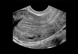 Overall, it is estimated that transvaginal ultrasonography has a sensitivity of 79% and specificity of 85% for the detection of adenomyosis. Pelvic Ultrasound Scan Private Well Woman Scans Ultrasound Direct Com