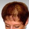 Dans l'alopécie androgénogénétique de la femme, la perte de cheveux est caractérisée par une diminution centrale (en sapin de noël) et le respect de la ligne frontale. 1