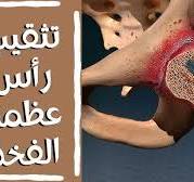 ‫جراحة تثقيب رأس عظمة الفخذ (تثقيب التأكل النكروزي بمفصل الحوض)‬‎