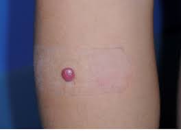 Image result for Spitz Nevus