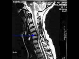 Treat Degenerative Disc Disease With Stem Cells Youtube