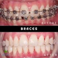 Before and after completed braces treatment by Klinik Pergigian Nash