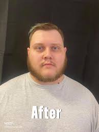 52 top Otoplasty Before and After ideas in 2025