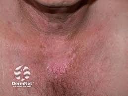 Image result for Photodermatitis