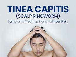 Image result for Tinea Capitis