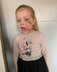 An XL Bully disfigured my daughter