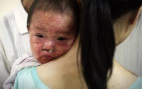 7-bien-chung-dang-so-benh-soi: Tin tức, Video, hình ảnh 7-bien-chung-dang -so-benh-soi