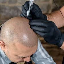 5445 dtc pkwy ste 1015. Scalp Micropigmentation Denver Co Licensed Scalp Pigmentation