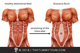 Find the perfect male abdomen anatomy stock photo. Diastasis Recti In Men The Tummy Team Online Core Rehabilitation The Tummy Team