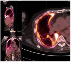 Ct scan showed compartmentalized interloop hypodense fluid collection throughout the mesentery with associated fat stranding and small . Prognostic Value Of Pretreatment Volume Based Quantitative 18f Fdg Pet Ct Parameters In Patients With Malignant Pleural Mesothelioma European Journal Of Radiology