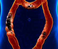 Ifølge mayo clinic , skal du kunne se lægen , hvis du har tilbagevendende. Tarmkreft Sykdommen Som Gir Symptomer Sent Alt Om Din Helse