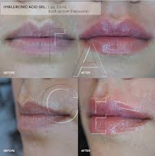 To achieve this the theoretical knowledge and understanding of the anatomy and physiology. Hyaluronic Acid Gel Faq Oakland Ca Face