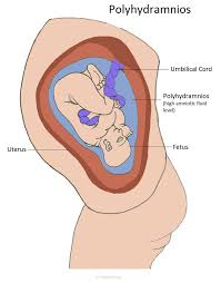Polyhydramnios Pregnancy Articles