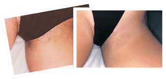It can be difficult to wait around for hair to grow long enough so you can wax it, but the payoff is that you will have about three weeks of smoothness before it grows back. Alternative Waxing Procedures