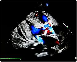 Mitral valve regurgitation, also known as mitral valve insufficiency or mitral valve incompetence, is the most common form of heart valve disease. What Is Mitral Regurgitation