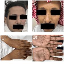 Image result for Diffuse Hyperpigmentation