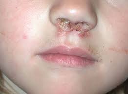 Image result for yellow scabs on the face in children
