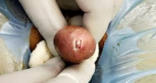 Rawatan perlu dilakukan segera sekiranya ia menyebabkan komplikasi. Fimosis Sekunder Selepas Berkhatan Klinik Dr Hasbi