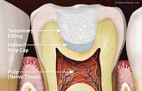 Maybe you would like to learn more about one of these? Pulp Capping