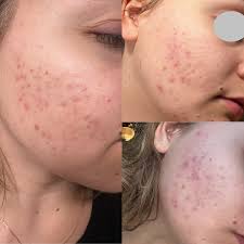 🥹3 month progress🥹 Closed comedones (those little tiny bumps under the  skin) are some of the harder acne to treat and I'm grateful yall choose me  to help you achieve healthy skin! *